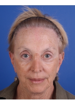After Hair Transplant&nbsp;Hair Thinning